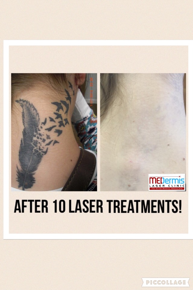 medermis laser tattoo removal in 10 treatments