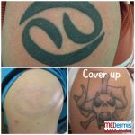 medermis laser tattoo removal for cover up in 6 treatments