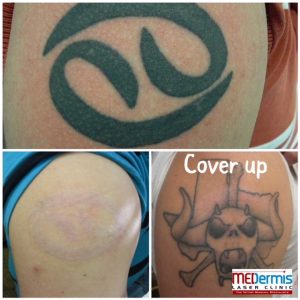 What Are the Pros and Cons of Tattoo Removal?