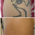 arm black tattoo on arm laser tattoo removal in 6 treatments