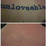 back laser tattoo removal on back in 8 treatments