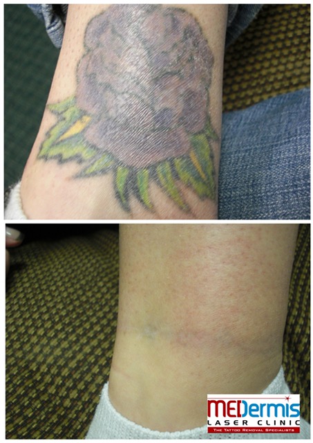 Ankle laser tattoo removal in 12 treatments