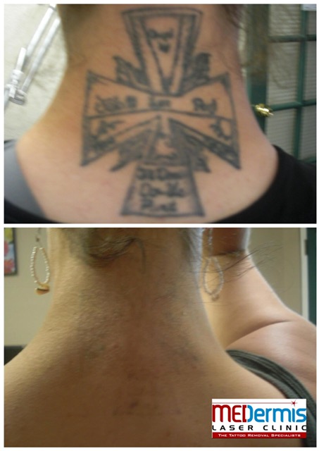 Neck laser tattoo removal in 8 treatments