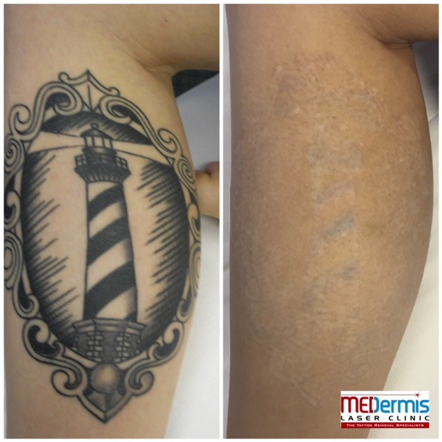 black leg tattoo laser tattoo removal in 8 sessions