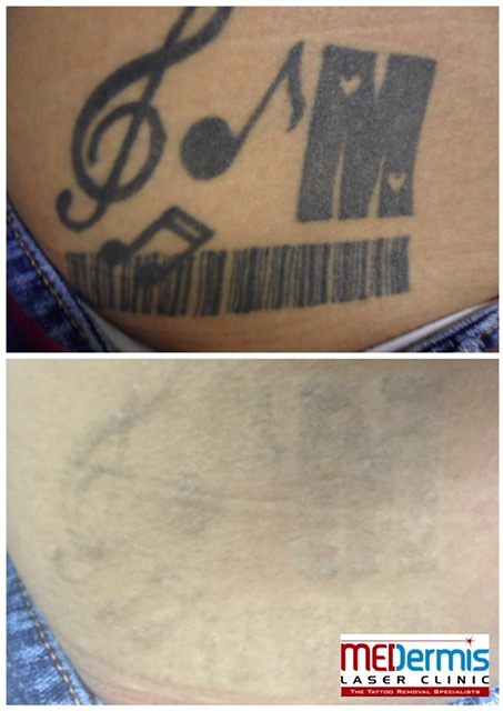 medermis laser tattoo removal in 9 treatments