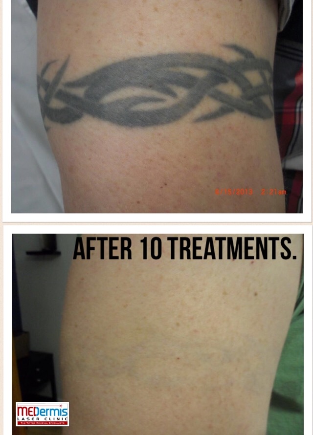 medermis Laser-Tattooentfernung in 10 Behandlungen