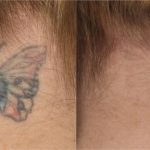 medermis laser tattoo removal in 7 treatments
