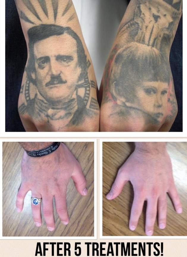 Zwei menschliche Gesichter Tattoos Tattooentfernung Handrücken