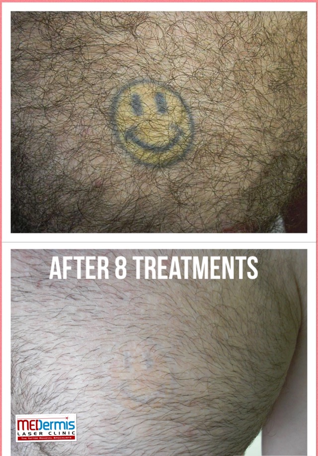 chest yellow and black ink laser tattoo removal in 8 treatments