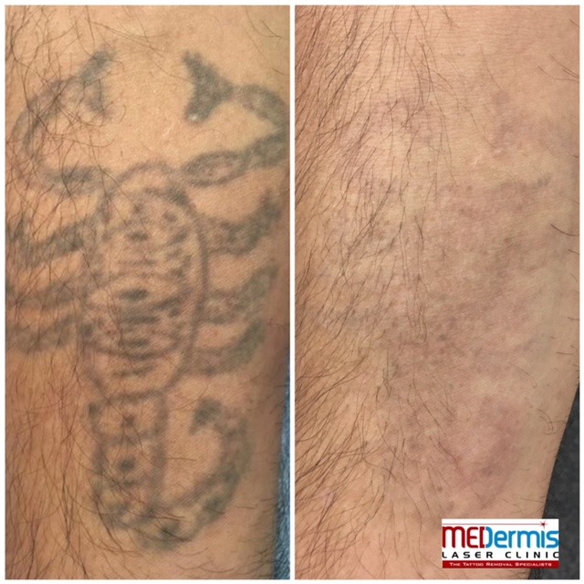 medermis Laser-Tattooentfernung in 2 Behandlungen