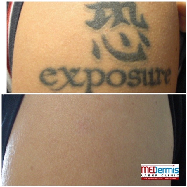 arm laser tattoo removal is the best in texas only 6 treatments