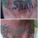 medermis austin laser tattoo removal in 8 treatments