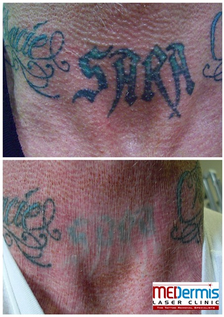 Results of removing ex-wife Sara's name on WWE The Undertaker's neck after 8 treatments