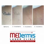 medermis laser tattoo removal in 6 laser treatments