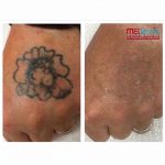 black tattoo back of hand laser tattoo removal