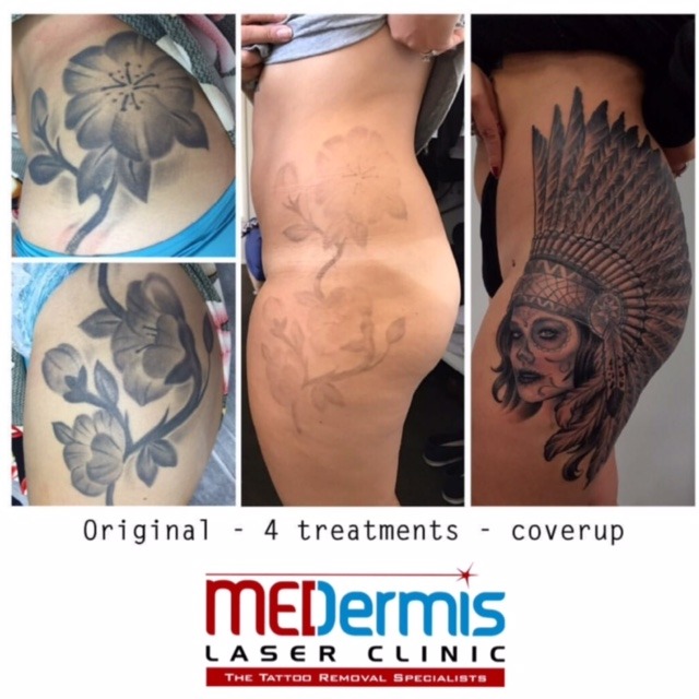 medermis laser tattoo removal for cover up in 4 treatments