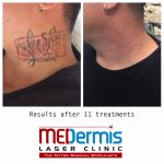 medermis laser tattoo removal in 12 treatments