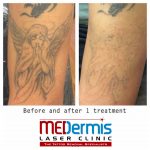medermis laser tattoo removal in 1 treatment