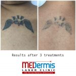 medermis laser tattoo removal in 3 treatments
