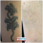 medermis laser tattoo removal in 10 treatments best of austin