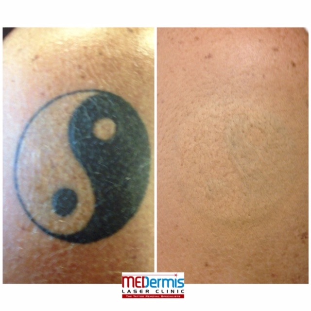 medermis Laser-Tattooentfernung in 6 Behandlungen