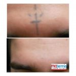 medermis laser tattoo removal in only 1 treatment