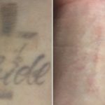 Wrist laser tattoo removal in 1 treatments