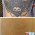 medermis the tattoo removal specialists laser tattoo removal in 10 treatments