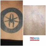 medermis laser tattoo removal in 10 treatments