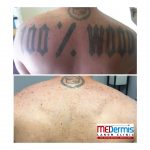 black tatto on back laser tattoo removal in 10 treatments