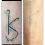 medermis laser tattoo removal best in austin in 4 treatments