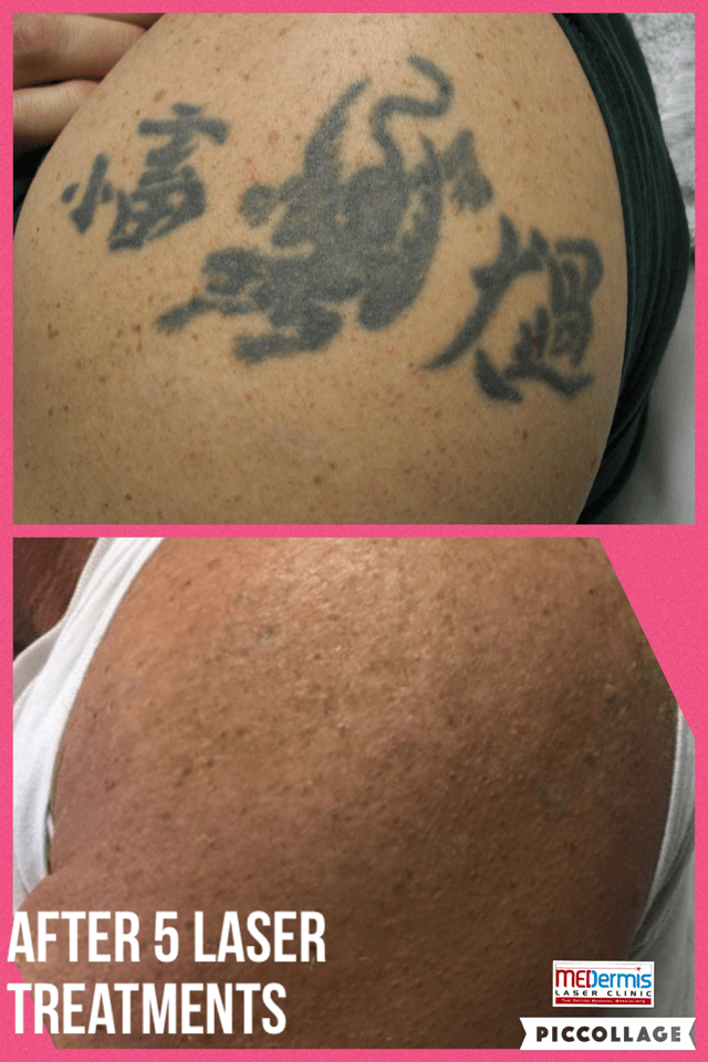 medermis Laser-Tattooentfernung in 5 Behandlungen