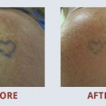 \"If you are wondering about the pain...its nothing worse than getting the actual tattoo, and its over in a matter of seconds! Trust me....Finding MEDermis Laser was the best solution by far.\" - M. Lopez