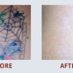 \"When it comes to having your tattoo removed, look no further. MEDermis has the best equipment and have the most experience specializing in tattoo removal.\"