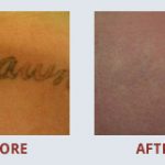 \"I\'ve had 5 treatments and the tatt is almost gone. My skin looks great! And I have just about put my big regret in the past.\" - AB - San Antonio, TX