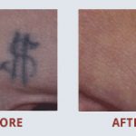 \"My tattoo is no longer visible, even close up. After finding myself in the awkward situation of a tattoo outlasting a relationship, I was pleased to find MEDermis Laser Clinic. I firmly believe it was the staffs expertise that made all the difference and got the results I\'d been hoping for. Thrilled to be rid of that damned thing! Thanks Martha!\" - Joseph