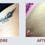 \"Very informative & professional. I would recommend Medermis to anyone that needs to get rid of a tattoo or two.\" - Angela