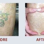 \"I wished I would have contacted MEDermis a long time ago. My ankle tattoo is almost completely gone and I am so happy and thankful to MEDermis Laser Clinic. I highly recommend anyone seeking a tattoo removal to leave it to the experts at MEDermis Laser Clinic! The atmosphere was so comfortable and each treatment only took about two minutes.\" - Crystal
