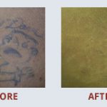 "I've been hesitant to get my tattoo removed because I wasn't able to find a good place that I was comfortable with. The staff at Medermis made me feel relaxed and they were very helpful and friendly. It only took one treatment and my tattoo is gone. If you're looking for a professional and friendly staff, then this is the place."