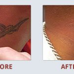 neck tattoo laser tattoo removal in 6 treatments