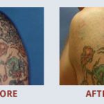 "I just want to send out a quick message and tell everyone there THANK YOU for helping me with my tattoo removal. Iris, Martha, and Mike have been just super fantastic."