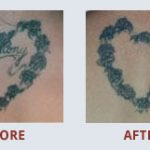 "During the free consultation, MEDermis Laser Clinic explains the process of getting removal work done, gave great advice on how to take care of it, and the pricing was very reasonable."