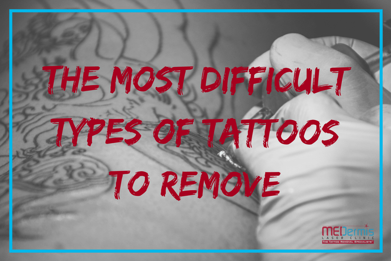 The Most Difficult Types of Tattoos to Remove - MEDermis Laser Clinic Tattoo Removal