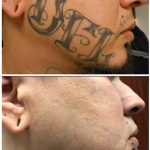 medermis san antonio laser tattoo removal in 14 treatments