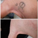 small black round symbol tattoo removal hand