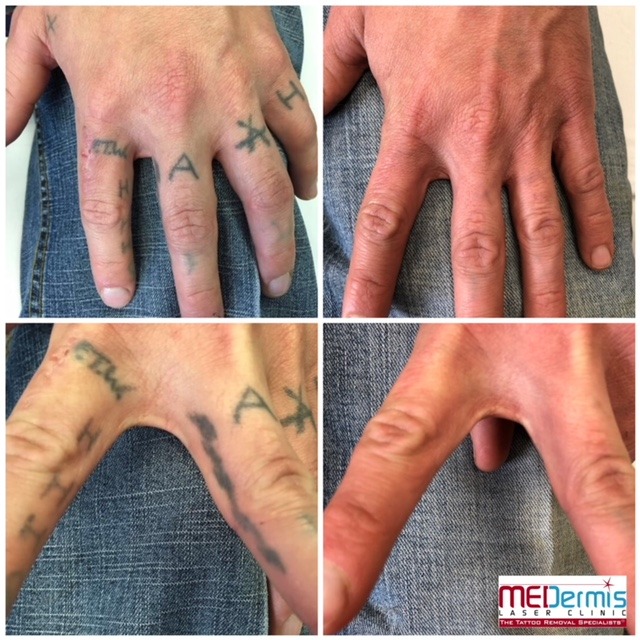 letters and symbols tattoo removal fingers