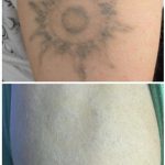 arm laser tattoo removal in 3 treatments