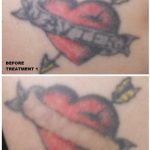 partial laser tattoo removal in 3 treatments