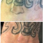 medermis laser tattoo removal in 4 treatments