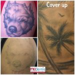 laser tattoo removal for cover up in 4 treatments